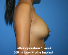 plastic-surgery-breast-augmentation
